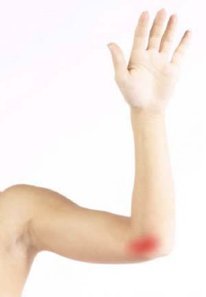 Cubital Tunnel Syndrome(Ulnar Nerve Entrapment) 