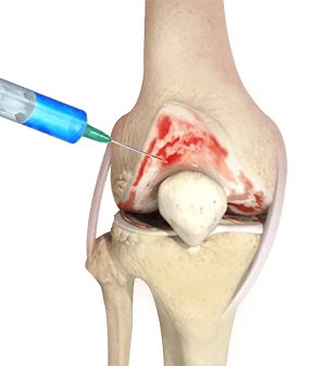 Hyaluronic Acid Injections