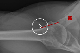 Humeral Preparation in Anatomic Total Shoulder Arthroplasty